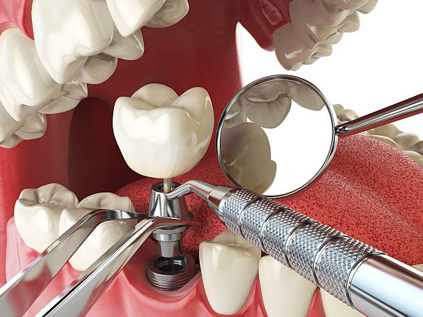 Best Emergency Treatment for Dental Infections or Abscesses in Olivet, MI